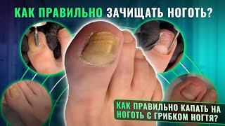 Как правильно зачищать ноготь? Как правильно капать на ноготь с грибком ногтя?