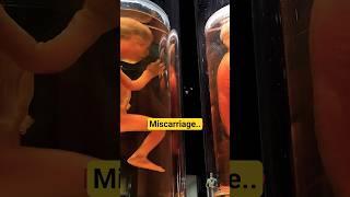 Why Miscarriage Happens: The Truth No One Talks About#miscarriages #medicalanimation | by DrLi‍️