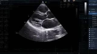 Transthoracic Echocardiography (TTE) - A Standard Examination