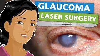 Glaucoma Laser Surgery