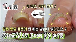 나이키 같은 내성발톱 통증 때문에 안해본 방법이 없다고요.? 3to교정으로 드디어 통증에서 해결~ #내성발톱 #레푸스 #시원 #제거 #발톱 #균집 #무좀 #무좀발톱 #toenail