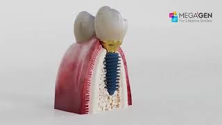 Імплантація зубів Megagen Anyridge Dental Implant