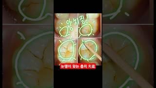초기 충치 치료하면 망하는 이유