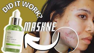 1 MONTH OF IUNIK Tea Tree Relief Serum on MASKNE | How to use IUNIK| acne prone sensitive skin