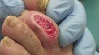 Bone Removal (Toe)