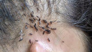 Pluck hundred head lice from short hair - Pick out many head lice from long hair