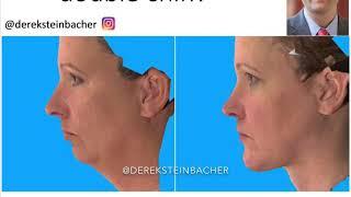 How to get rid of your double chin. Facelift necklift jaw surgery genioplasty kybella fat liposuct