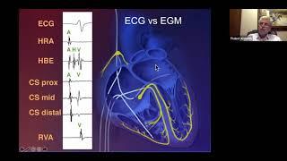 From Surface ECG to Intracardiac EGM  Part 1