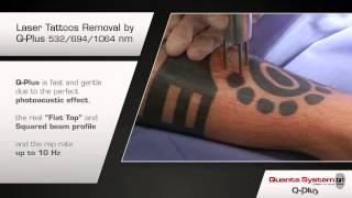 Tattoo Removal with the Q PLUS