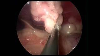 Spleen removal in a Dog Minimally Invasive Dr. Jeffrey j Runge DVM DACVS PennVET