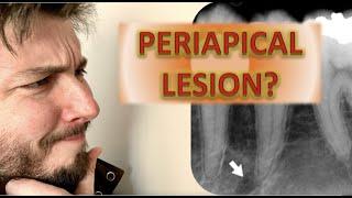 How to Identify a Periapical Radiolucency (Abscess, Cyst, Granuloma: Root canal infection x rays)