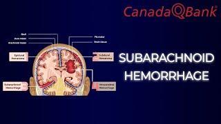 Subarachnoid Hemorrhage