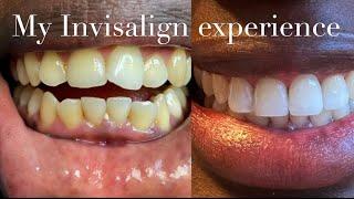 My teeth transformation with Invisalign