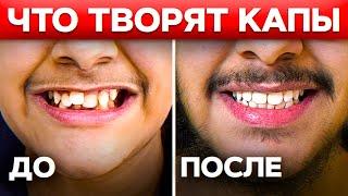 Как БЫСТРО выровнять зубы БЕЗ БРЕКЕТОВ? РЕЗУЛЬТАТ 100% / Современная ортодонтия