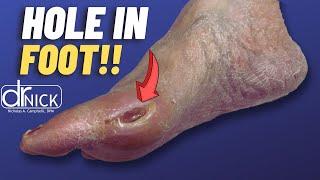 Repairing a Big Toe Ulcer | Dr Nick Campitelli