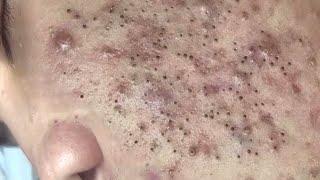 Hana #78: A blackheads field