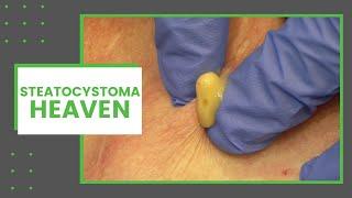 Steatocystoma Heaven | Dr. Derm