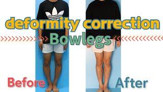 Different Surgical Methods For Bowlegs Correction