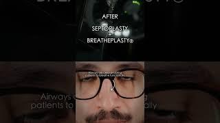 SEPTOPLASTY BEFORE AFTER #sinusitis #allergies #sinus #smell #congestion #breathe #nose #rhinoplasty