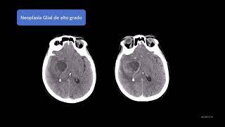 Radiología en 5 minutos: Neoplasia Glial de Alto Grado.