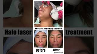 Halo Laser Resurfacing Treatment At Face It Botox Bar