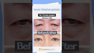 Korean lower blepharoplasty from Symphony Plastic Surgery Korea #shorts