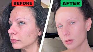 How to Fix Hyperpigmentation & Dark Spots? - FAST & Inexpensive