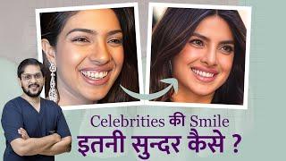 Celebrity Smile Makeover | What is Smile Design  | Dental Veneers in Indore