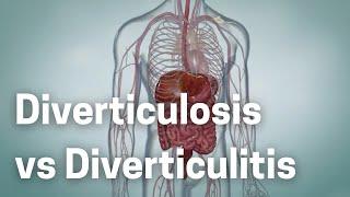 Diverticulosis vs Diverticulitis: The Silent Threat Inside Your Gut!