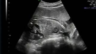 Matt & Bridget's Ultrasound of Baby Boy @ ~20 weeks