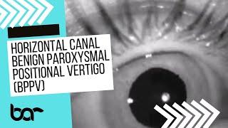 Eye Movements for Horizontal Canal BPPV(TDTM episode 2)