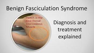 Benign Fasciculation Syndrome Causes and Treatment