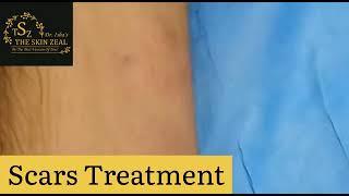 Scars treatment in zirakpur | The Skin Zeal | 72-93-93-93-26