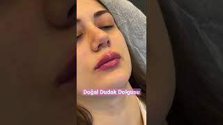 Doğal Dudak Dolgusu #dudakdolgusu #estetik