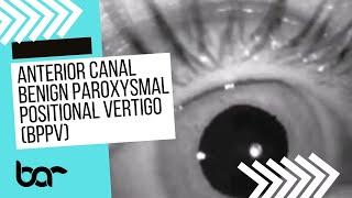 Anterior Canal BPPV blog video