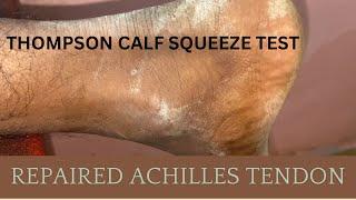 POST REPAIR TORN ACHILLES TENDON | THOMPSON CALF SQUEEZE TEST #AchillesTendon