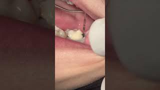 Second molar tooth  class V glass ionemar restoration #dentist