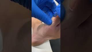 Expert Toe Callus Removal by Australian Podiatrist with Scalpel | Effective Foot Care! 