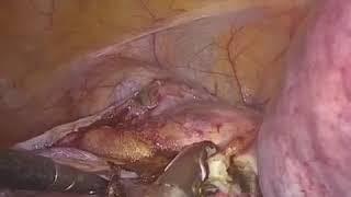 Total Laparoscopic Hysterectomy | Dr. Sushmita Mukherjee