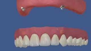Имплантация на 2 имплантах съемный протез