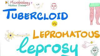 Leprosy - Tuberculoid Leprosy vs. Lepromatous Leprosy - Comparisons Playlist