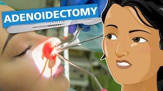 Adenoidectomy