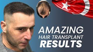 Transes Hair Transplant Patient   #hairtransplant From TURKEY