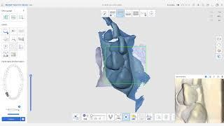 Réaliser simplement vos couronnes sous châssis - MEDIT LINK TUTORIEL