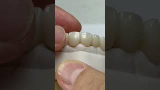 Hygiene Pontic from implants!