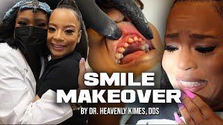 The ULTIMATE Smile Makeover  جراحی کاشت ونیر چینی روی هم | لبخند از دکتر آسمانی