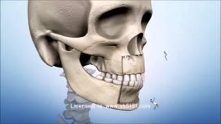 ASO, Anterior Segmental Osteotomy, Bimaxillary protrusion, bird face, 돌출입