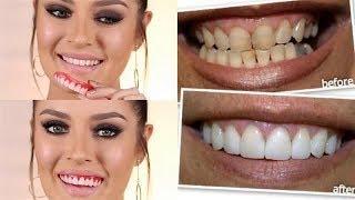 накладные виниры perfect smile купить