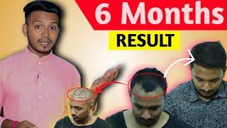 3500 Grafts Surgery,Creating A Natural Hairline In Kolkata 1a Single Days