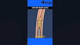 Kidney stone treatment | RIRS Ureteroscopy | Ureteric Stone removal | Laser treatment #shorts